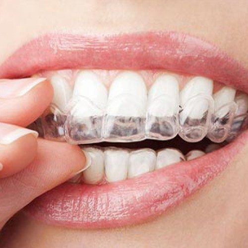 Caring for Your Braces: Tips for Maintaining Optimal Oral Health